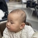 에스앤유현대의원 | 아기 이소성몽고반점 <에스앤유피부과>