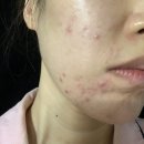 한국농아인협회 강원도협회 원주시지부 | 원주 기업도시 피부관리 찐 후기 원래 좋았던 것처럼~