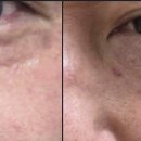 제이비코리아 | [피부관리]점·기미·색소 일주일 완 송정빈박사 제이비뷰티코리아 그레이스송 점빼기 리프팅