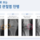 티케이정형외과 네이버블로그