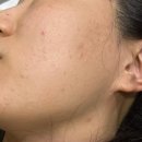 원한의원 | 좁쌀여드름 치료, 몇백만 원 쓴 내가 광주 한의원에 정착한 이유(내돈내산 후기)