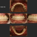 제이앤피웰치과의원 | 세종시치과추천, 디지털 임플란트 선택하는 이유는?
