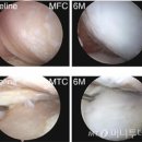 무릎 퇴행성 관절염에도 치료 이미지