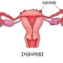 자궁내막증 증상 원인 수술 치료 (생리통증상 골반통증 임신) 이미지