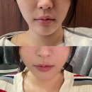 강남고운세상피부과의원 | [강남역 피부과] &#39;팔자주름 민트실 리프팅&#39; 찐후기