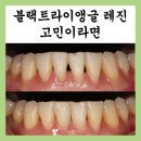 블랙트라이앵글 레진후기, 교정 후 생겼을때 대처법?