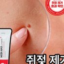 쥐젖 제거 비용 쥐젖 원인 증상 치료 쥐젖 연고 이미지