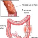 궤양성 대장염 원인 좋은 음식 이미지