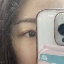차옴 | 소세지눈 재수술 일주일차 후기-의사쌤 경과 진료 보고옴 잘됐대요