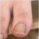 자인 정평 시지 내성발톱 무좀발톱 발톱무좀 발각질 케어 No.1 네일,그대와 닥터아이티엔