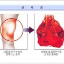 골육종 - 뼈에 발생하는 악성 종양 원인/증상/치료 이미지