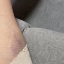 용가리네노리터 | 20대후반 눈밑지방재배치, 지방이식 내돈내산 솔직후기 :: 멍, 붓기 (눈밑지 수술 1일차~5일차)