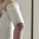 밸런스성형외과의원 | 압구정 성형외과 팔뚝 복부 허벅지 지방흡입 내돈내산 리얼 후기