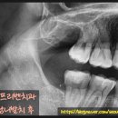 서울프리벤치과의원 네이버블로그