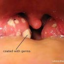 급성 편도염[acute tonsillitis] 이미지