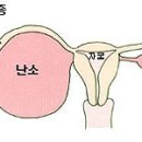 ....난소물혹 - 난소낭종 이미지