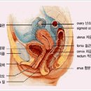 자궁근종과 치료 방제 이미지