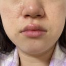 아크릴리아 | 올리브영패치추천 큐어시스 트러블니들패치 스팟패치 두종류 비교 사용해본 솔직 후기 비포에프터 확실함