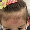 더윤피부과의원 | 더윤피부과 진료 후기(하은이 이마 상처-에스로반연고 처방)