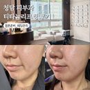 길지 | 청담 티타늄 리프팅 유지기간 전후 솔직후기