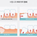 새롬치과의원 | 청주가경동치과, 매복 사랑니 발치를 고민할 때 먼저 알야야 할 부분