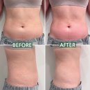 정석그린프라자 | 천안 바디관리 · 바디관리 잘하는 곳 l 수봄에스테틱 천안불당점 울트라 바디 셀 컨투어 후기