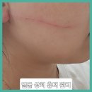 ■얼굴 흉터 관리