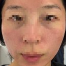 늘봄피부과의원 | 광주늘봄피부과)여드름,모공 포텐자 고주파 내돈내산후기