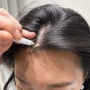 m헤어 | 강남 헤어라인 문신 내돈내산 솔직 후기(M자 헤어라인, 두피흉터 문신, smp)