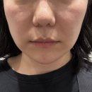 라임 | 청담피부과 울쎄라피프라임 효과 통증 내돈내산 후기