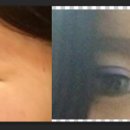 비케이한국성형 | <<압구정/신사 성형외과 상담 투어>> 길고 길었던 성형 투어의 종결! 26일날 쌍수함!!!