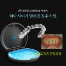 문정동라임치과 인비절라인을 이용한 치아 사이가 벌어진 경우 치료