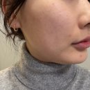 해뜨는한의원 | 영등포여드름흉터 한의원 율각테라피 내돈내산 색소침착 관리 후기