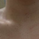 지성프린트 | 합정 편평사마귀 성지 병원 - 편평사마귀 어붐야그 레이저 제거 내돈내산 후기