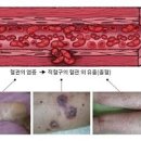 다리 피부 혈관염 원인 증상 치료 예방 이미지