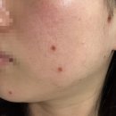 순한의원 | 연세화온의원 피부과에서 점뺀 후기 점뺀후 관리 대전 유천동피부과 추천