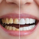 미서울치과의원 | 광주계림동치과 전문가미백 vs 셀프미백 차이는?