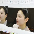 청담엔샤인의원 | 내돈내산 청담피부과 온다리프팅 관리전후 후기, 부작용은?