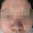 바로그의원 | [대전 피부과 후기] 점빼기+프락셀 솔직 내돈내산 후기 | 봉명동 바로그의원 유성점