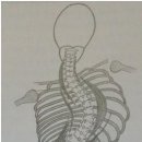 울산 척추 관절 측만증 박병원 - 허리 측만증 이미지