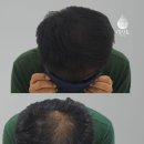 해담Q마트 | 전주두피문신, 텅 빈 가르마를 채우는 가장 확실한 방법
