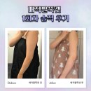 바디닥터 | 닥터손유나의원 바디캣 팔뚝 시술 1회차 후기 I 매직팔뚝캣 솔직 경험