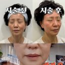 강남-094 | 아리아라스킨랩 Ι 광교 피부관리 바이오폭스 BioFox EGF 찐후기