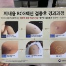 심낭골 | BCG 접종 언제 맞아야 할까? 접종 시기, 종류, 관리방법, 접종 후 경과과정, 피내용 경피용 접종 후기 정리