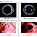 국내 의료진 개발 인공각막, 미국 교과서 소개 이미지