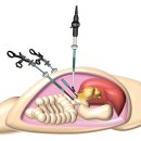 Olympus LFT type V3 Laparoscopy ENDOEYE HD Camera 이미지