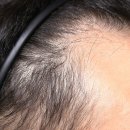 김포풍무신경외과의원 | 김포탈모병원 리제네라액티바 줄기세포 탈모치료, 3개월차 솔직한 후기