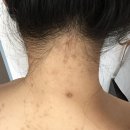 미강의원 | 등드름 리유한의원 미강약침 받고 끝냈는데 유지 잘되네요^^