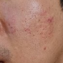 선명한의원 | 여드름흉터한의원 제거 과정 방법 후기