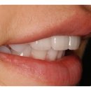 [치아성형] 삐뚤어진 돌출치아 치아성형으로 예뻐지기 이미지